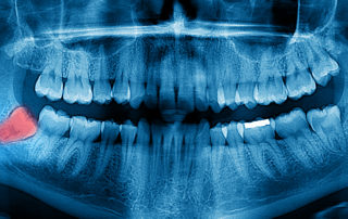 Impacted wisdom teeth