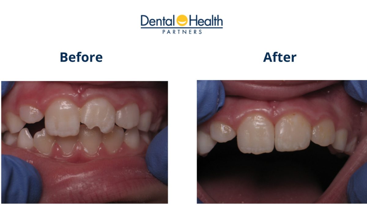 Composite Bonding | Before and After Tooth Restoration - Dental Health