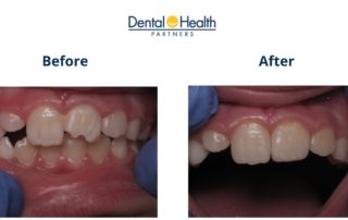 Composite Tooth Bonding | Before and After