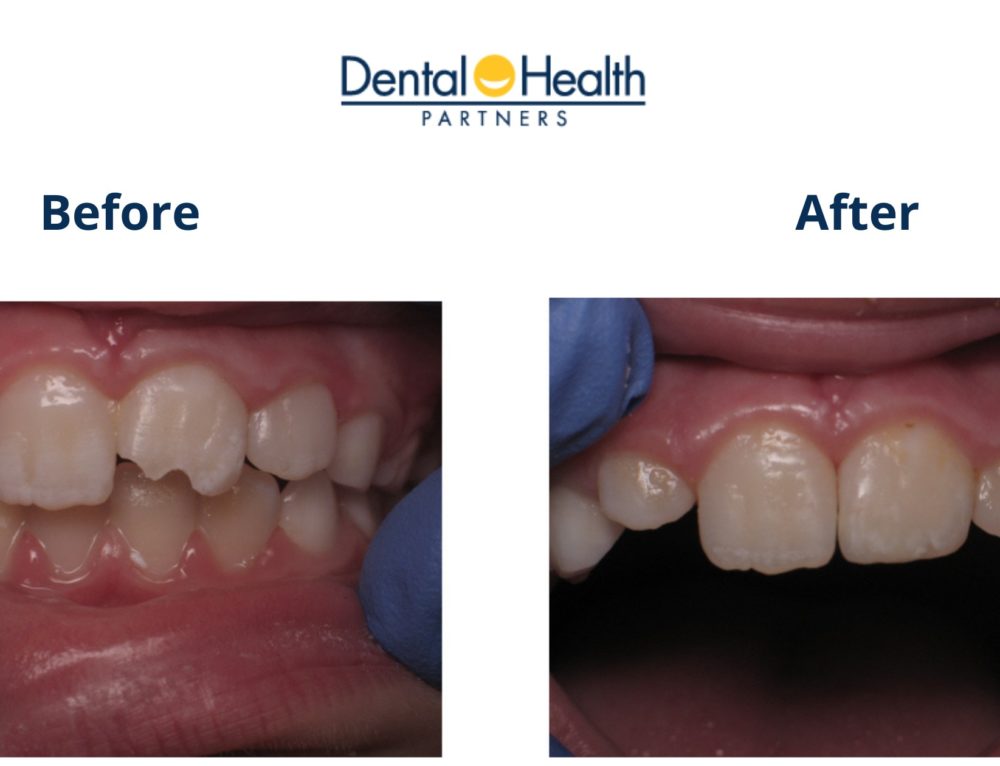 Before & After Lateral Incisor Bonding Removal, Composite Reapplication
