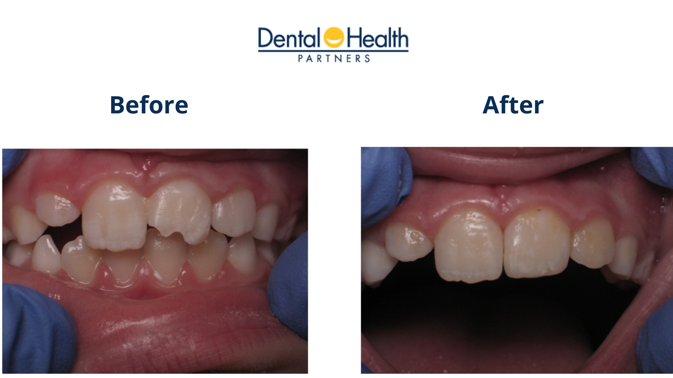 Composite Tooth Bonding | Before and After