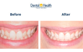 Before & After | Lateral Incisors Bonding Removal & Composite Re-Application