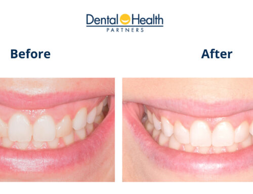 Before & After: Lateral Incisors Bonding Removal & Composite Reapplication