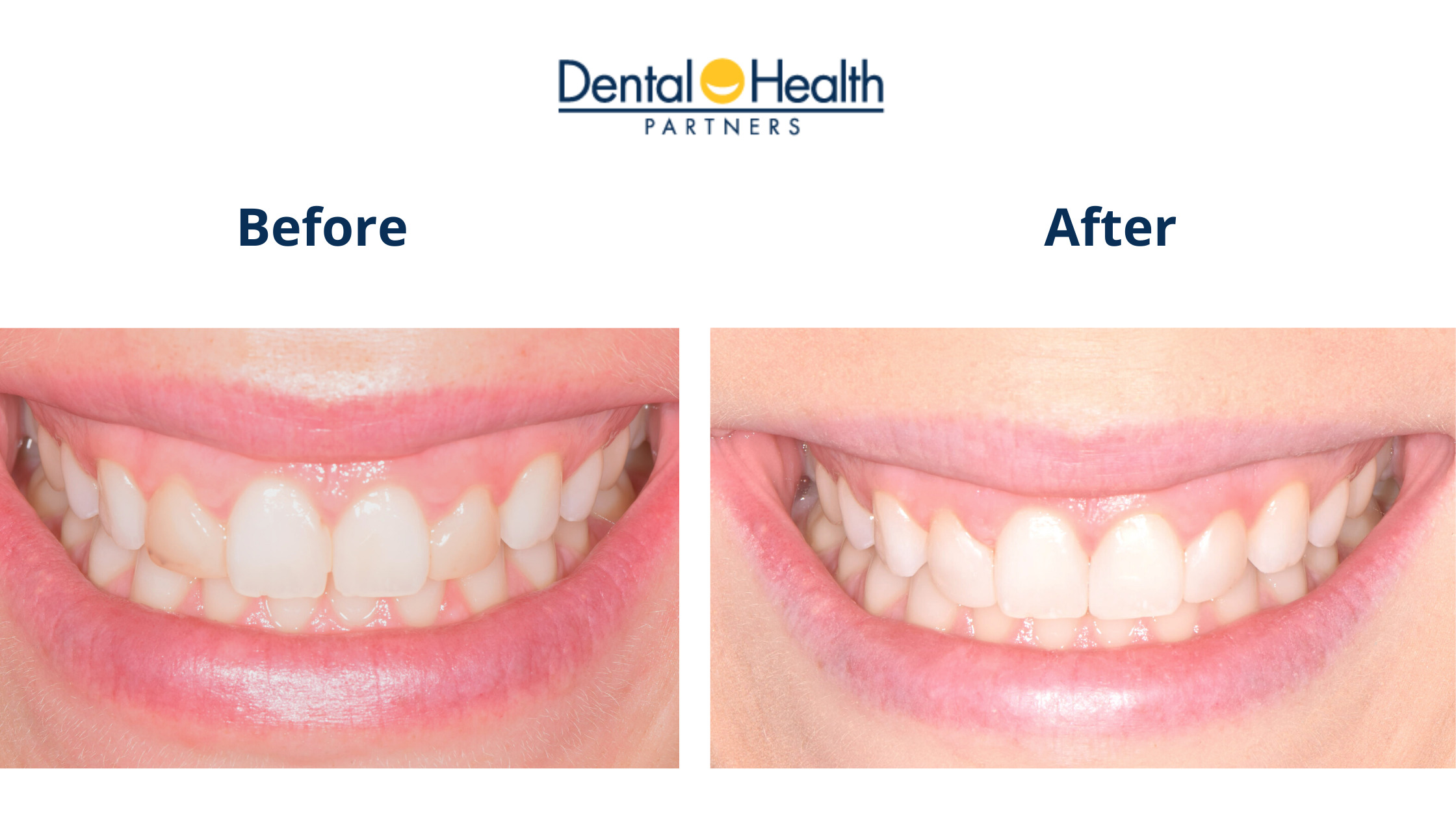 Before & After | Lateral Incisors Bonding Removal & Composite Re-Application