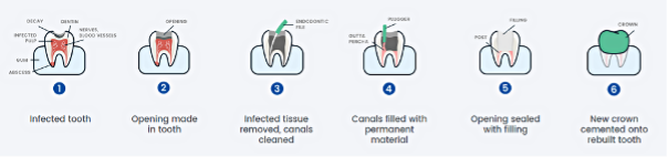 root canal process infographic